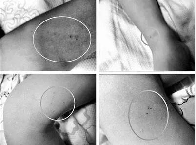 男童疑被老师针扎10处 园方辩称螨虫咬的