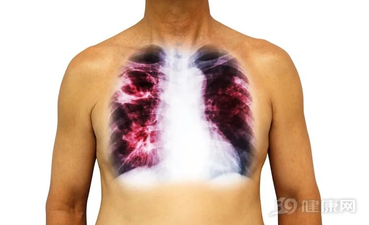 处在同一环境，有人得肺结核，有人却相安无事！为什么？