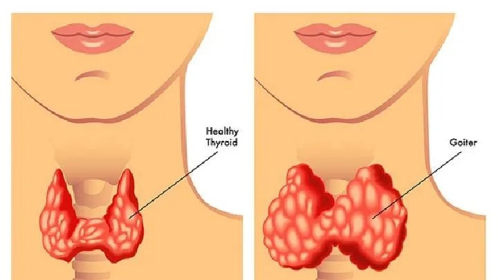 喉癌的症状表现是怎样的