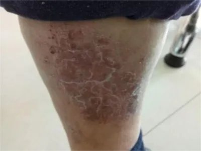 慢性湿疹小腿症状图片