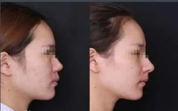 成都硅胶隆鼻医院哪里比较好