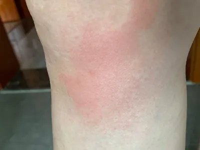 战壕热症状图片