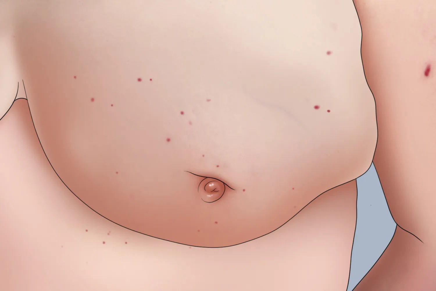 乳腺癌的前兆图片