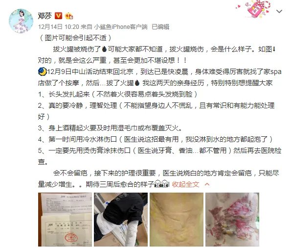 邓莎拔火罐被烧伤：火罐不是人人能拔，注意5个禁忌