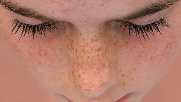 脸上长黄褐斑怎么回事