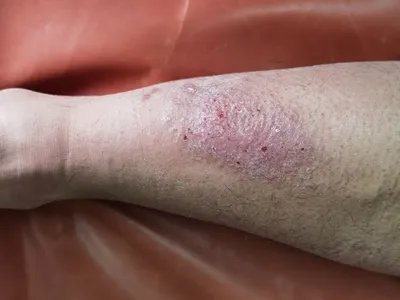 慢性湿疹小腿症状图片