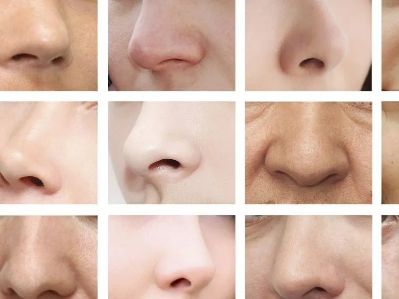 鼻翼法令纹怎么祛除