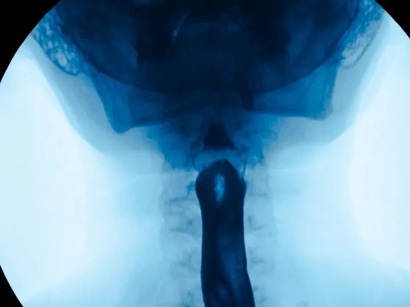 x光对精子有什么影响