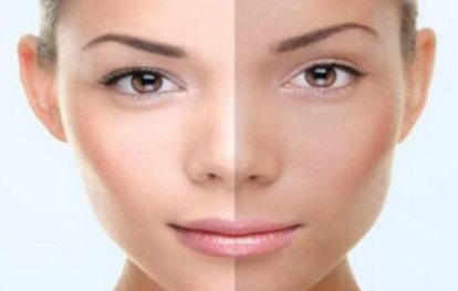 黑脸娃娃激光美容的注意事项