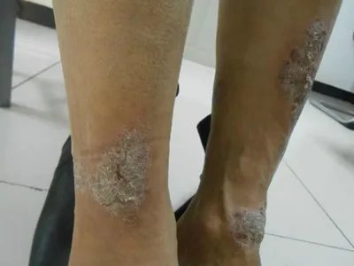 慢性湿疹小腿症状图片