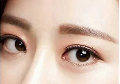埋线重睑术要注意什么