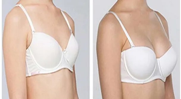 北京自体脂肪隆胸多少钱