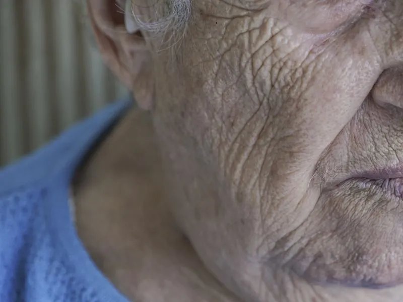 韩式无痕除皱是什么