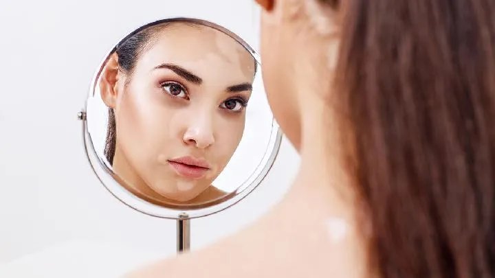 脸上黄褐斑怎么引起的