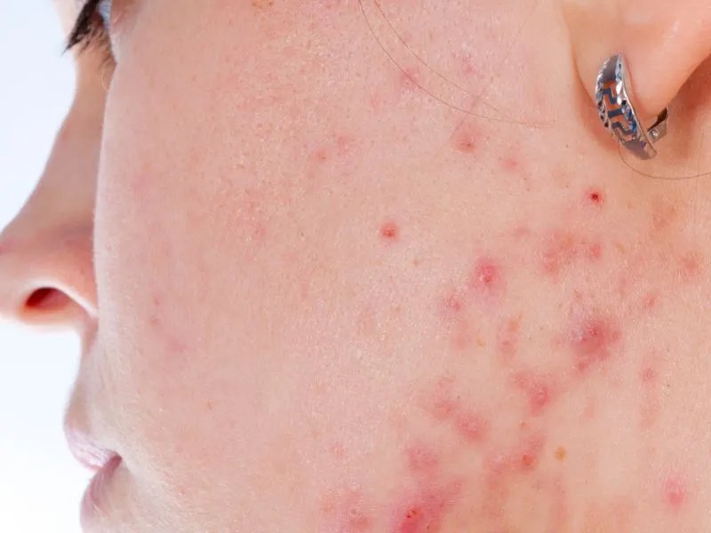 青年痤疮的治疗