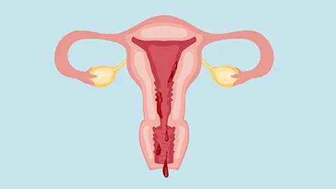 宫血症是什么原因