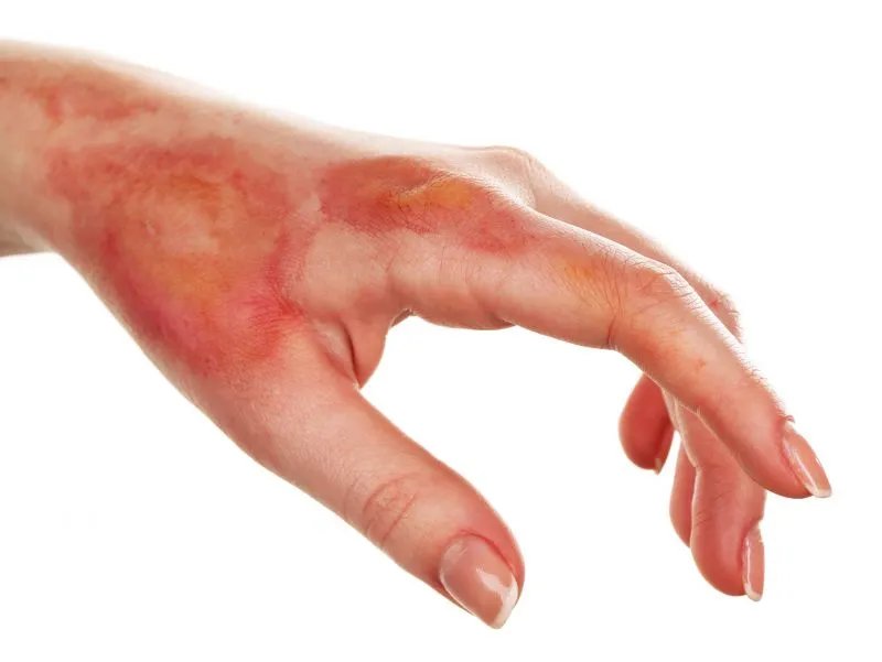 体癣的早期症状