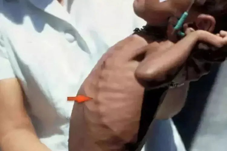 小宝宝佝偻病症状图片