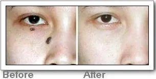 做手术去痣价格要多少