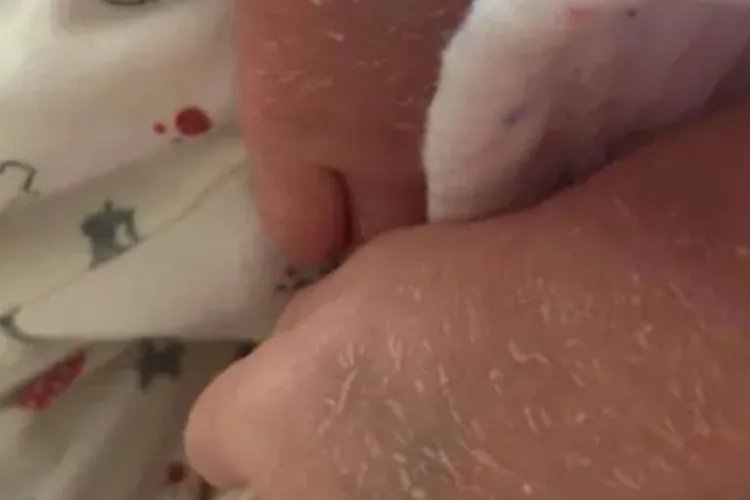 轻微鱼鳞皮肤病的图片