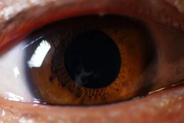 瞳孔放大图片和正常瞳孔图片