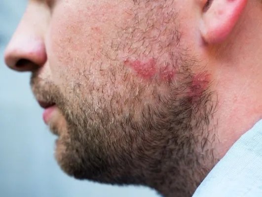 右脸痤疮的原因