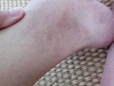 掌黑癣脚踝斑图片