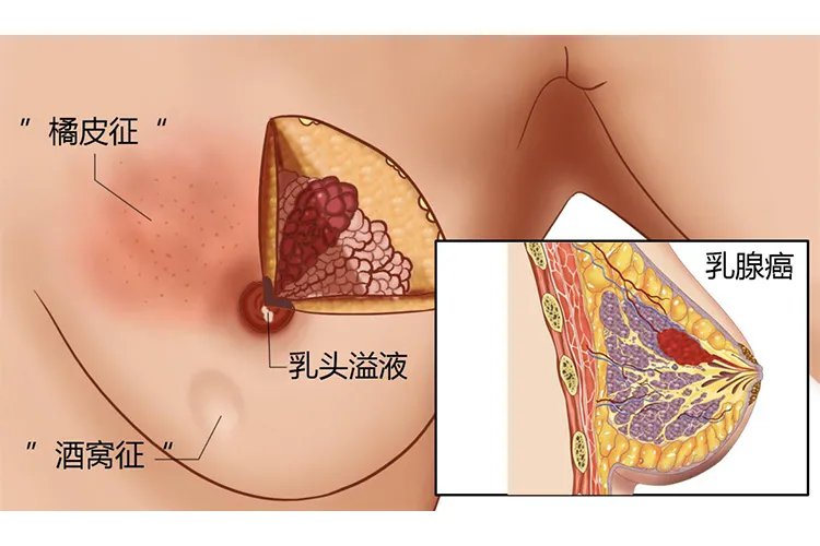 五张图认识乳腺癌早期