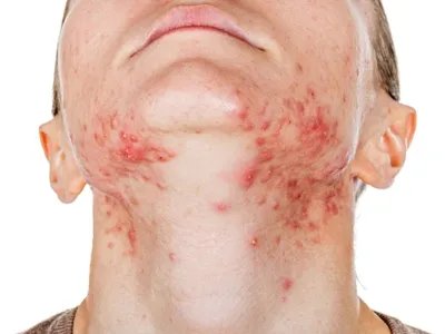 战壕热症状图片