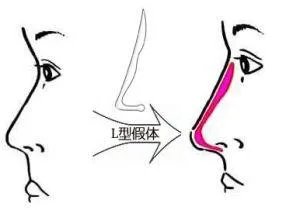 大鼻子怎么整容