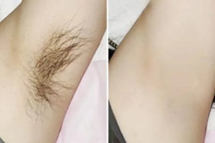 脱毛图片