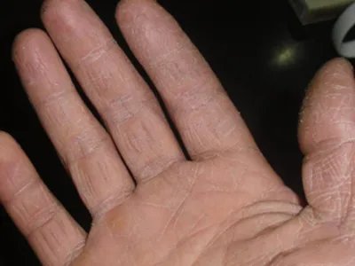 进行性指掌角皮症竖纹图片