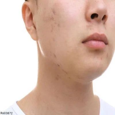 男人如何祛痘