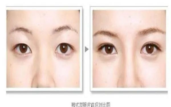 北京好的眼部手术整形医院在哪?