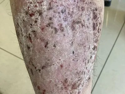 慢性湿疹小腿症状图片