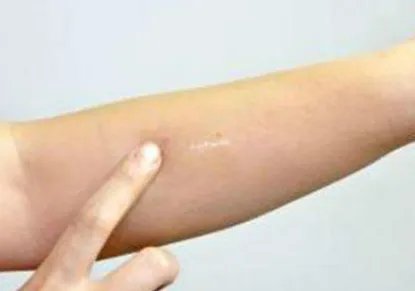 疤痕可以去掉吗