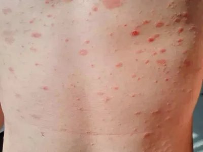 战壕热症状图片