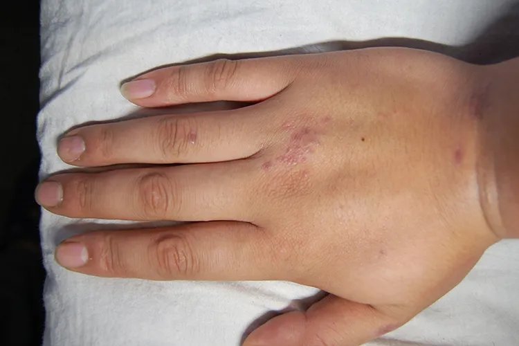 手上突然冒出紫色点点图片