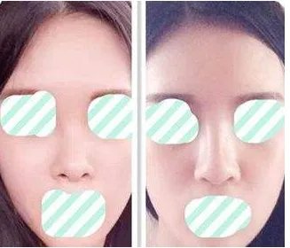 北京鼻部整形价格