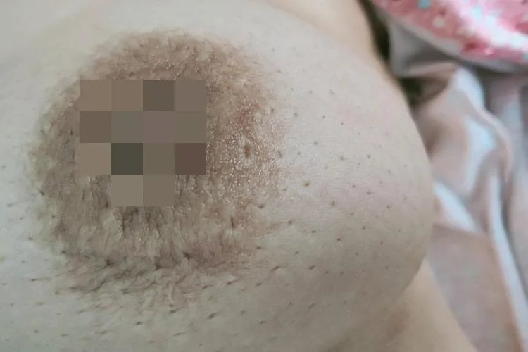 五张图认识乳腺癌早期