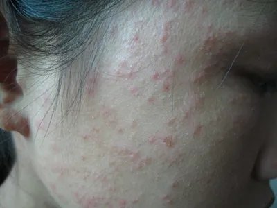 战壕热症状图片