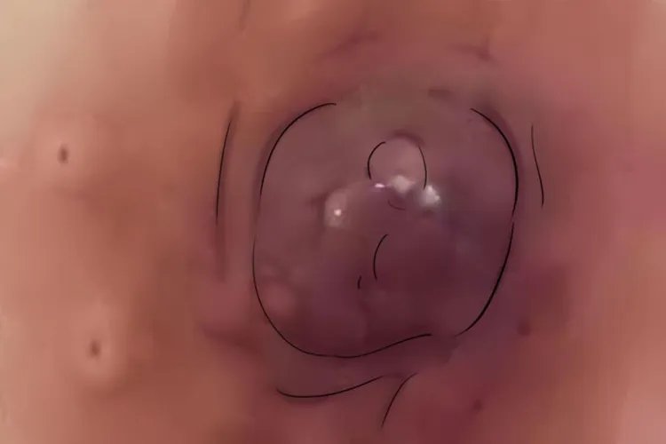 五张图认识乳腺癌早期