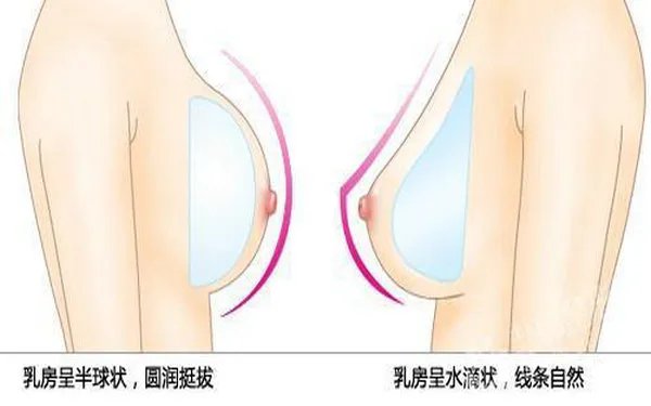 做妙桃假体隆胸多少钱