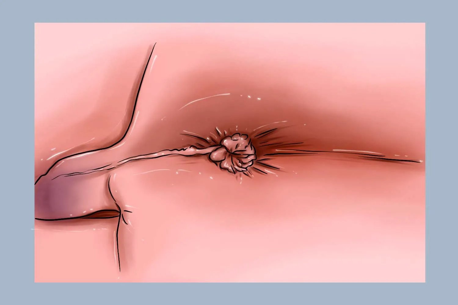 痔疮图片和正常图片