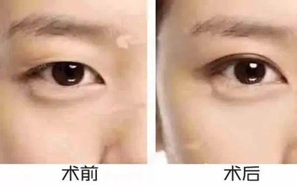 北京好的眼部手术整形医院在哪?