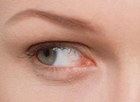 做眼袋手术优点