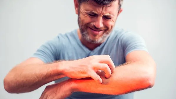 春季皮肤过敏怎么办