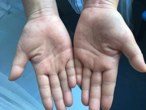 新冠期间更应注意消杀，为何新加坡还会爆发登革热？