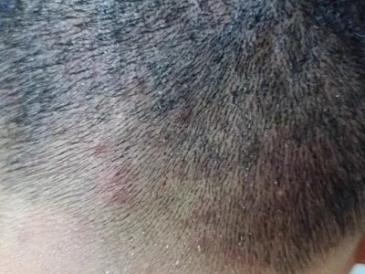 毛囊炎硬疙瘩图片