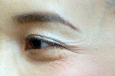 去鱼尾纹手术的危害